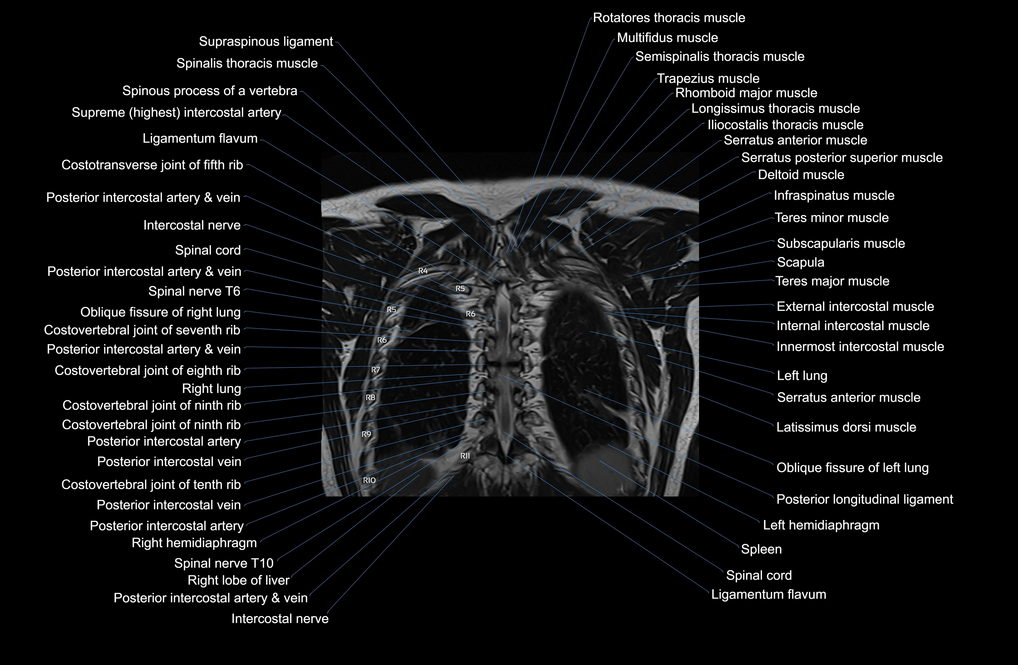 MRI chest (thorax) coronal  cross sectional anatomy 3T radiology  image-img-00001-00036.webp